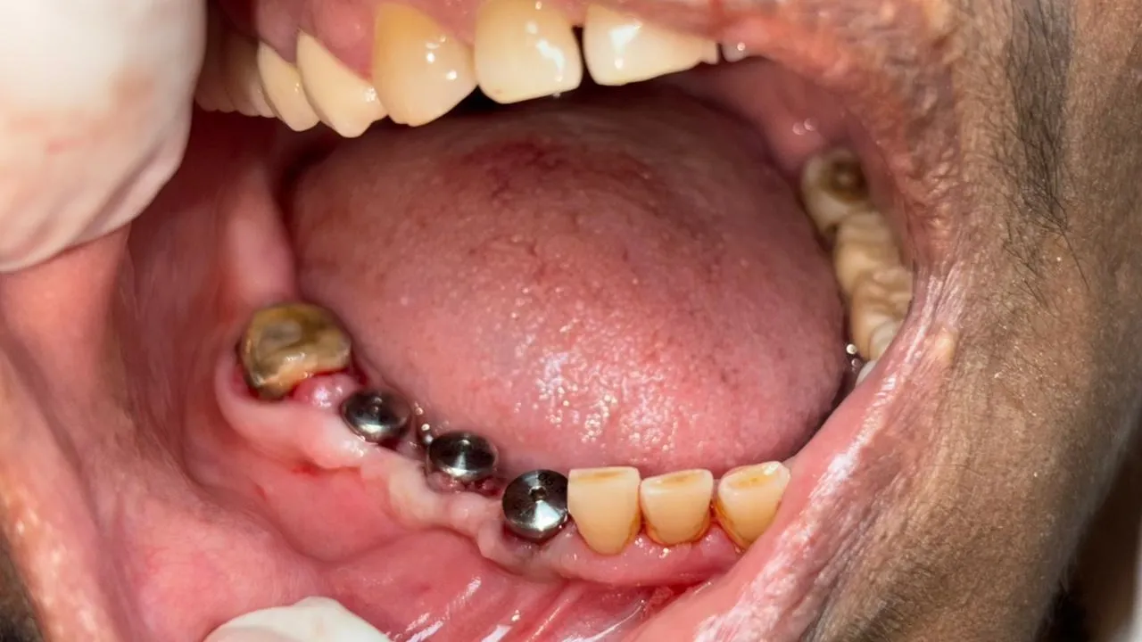 How Many Days Does It Take to Get a Dental Implant?