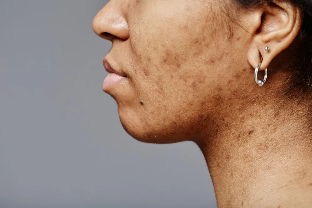 Pigmentation Treatment in Rani Bagh - Restore Even Tone and Radiance