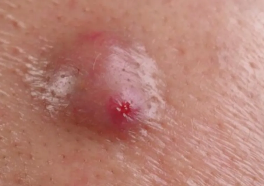 Sebaceous Cyst Removal in Kolathur, Chennai