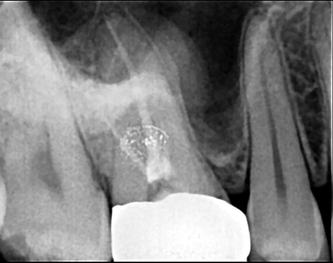 Dental Crown After Root Canal – Is It Compulsory?