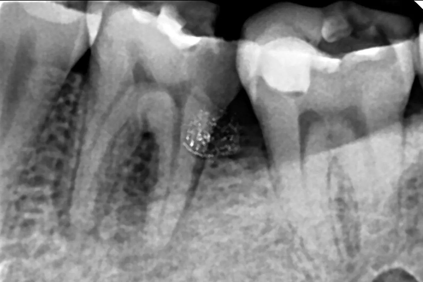 Signs That You May Need a Root Canal
