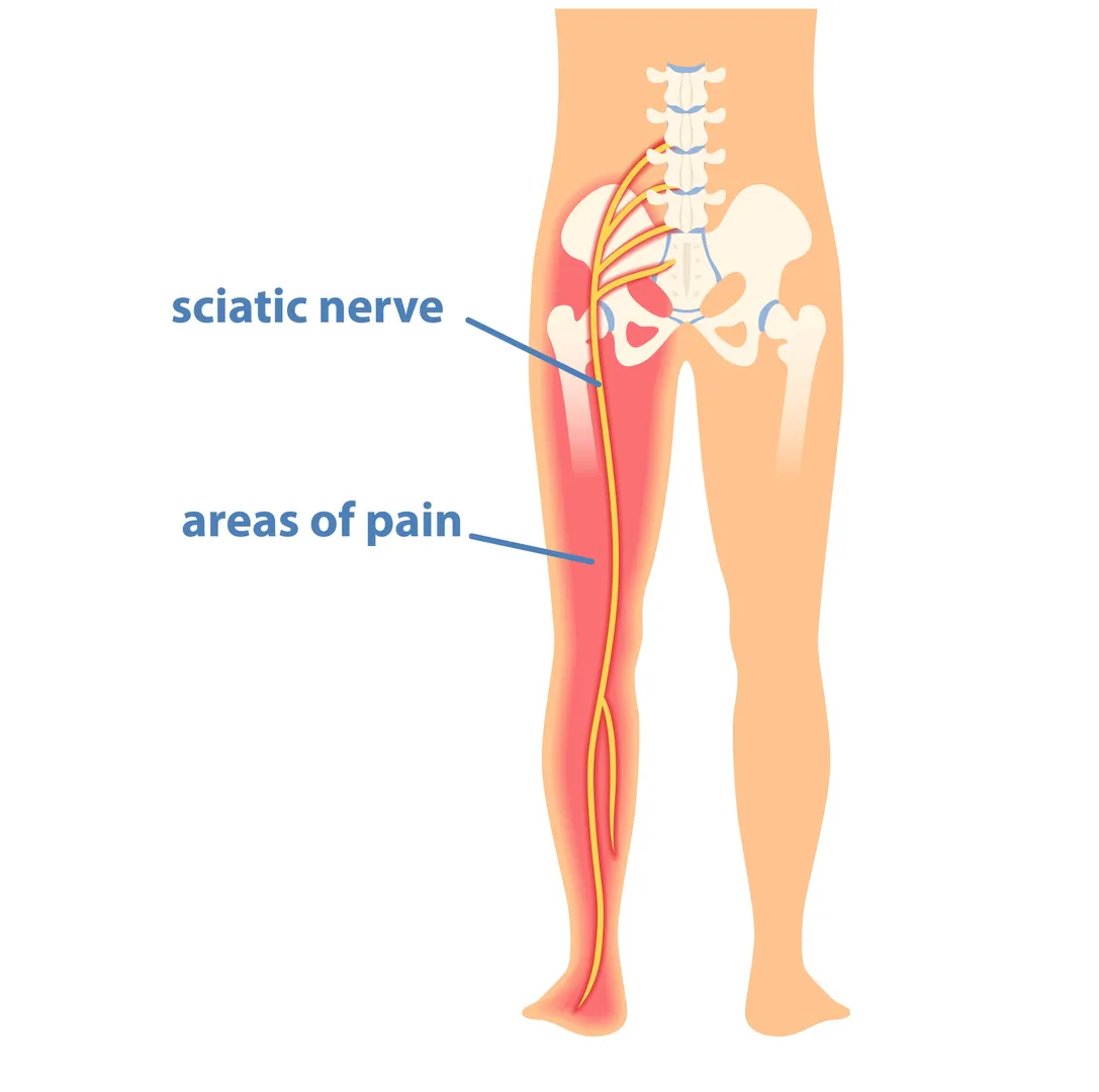 Sciatica Treatment in Noida – Find Relief from Radiating Leg Pain
