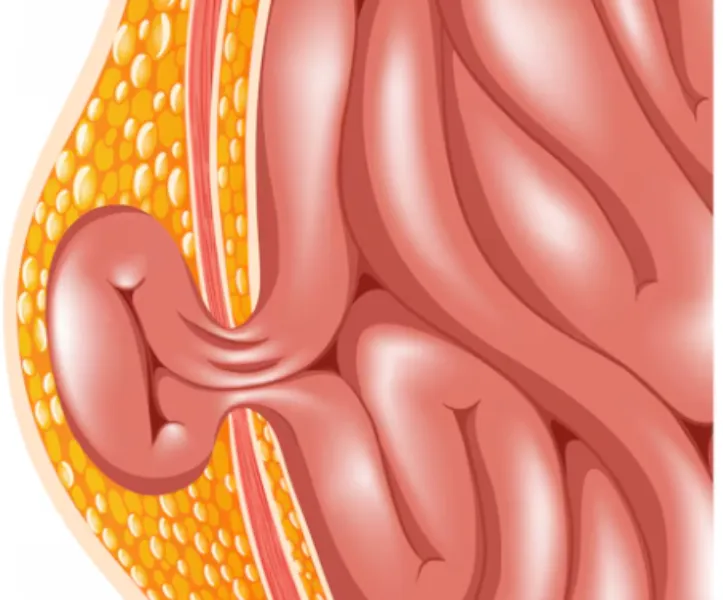 Advanced Surgical Solutions by the Best Laparoscopic Hernia Surgeon in Pune