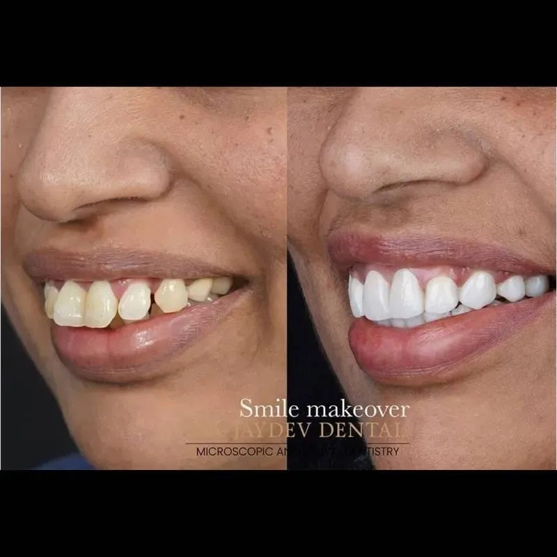 Best Smile Correction treatment In vashi