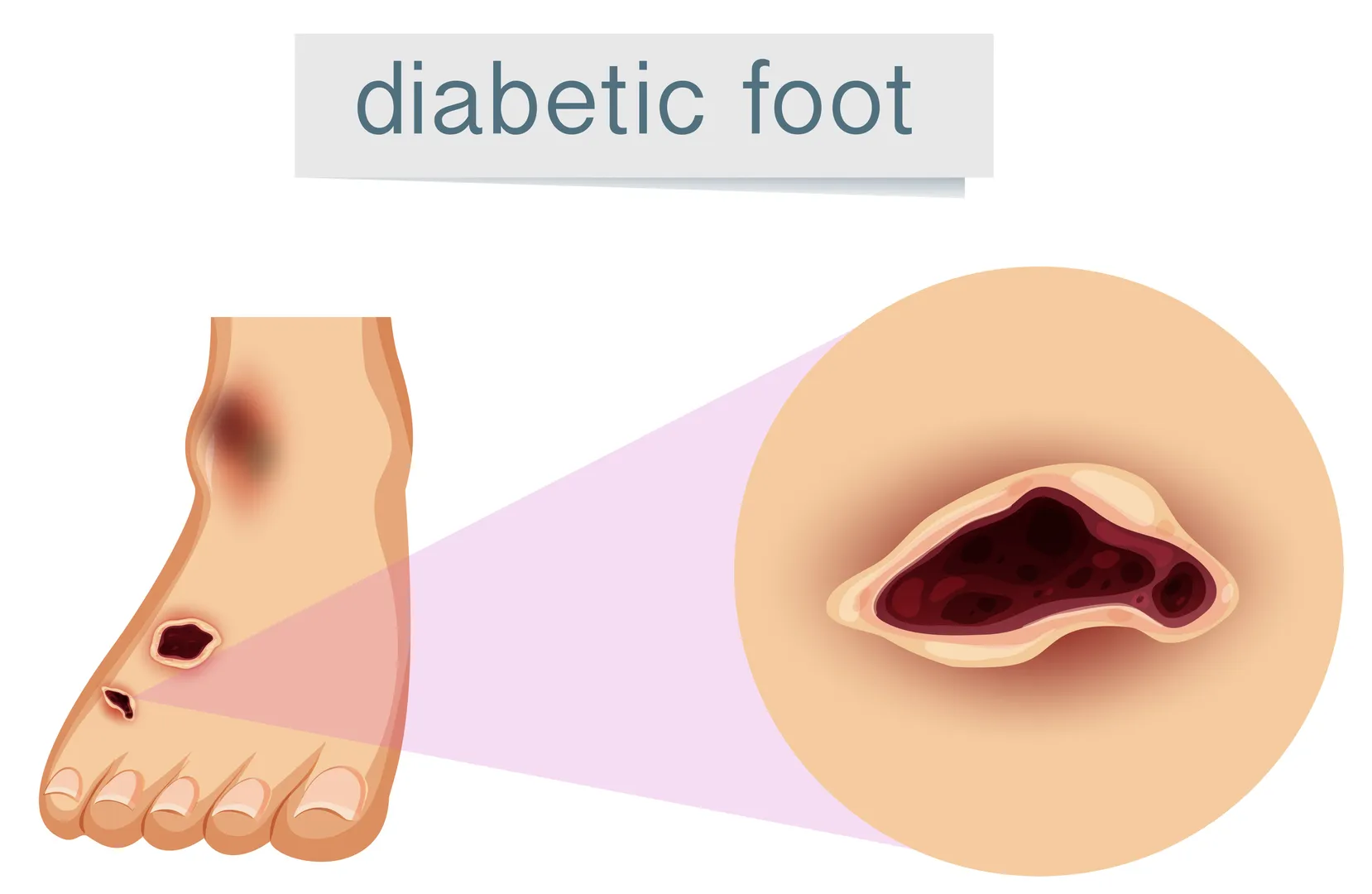 Diabetic Foot and Wound Surgery in Chembur for Limb Protection