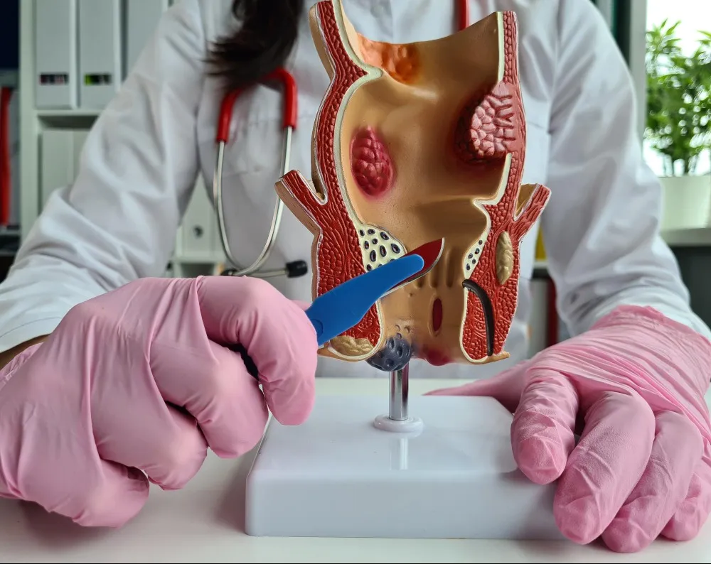 Fistula Surgery in Chembur for Safe and Complete Healing