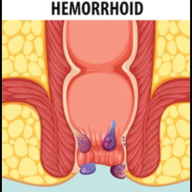 Hemorrhoid Treatment in Bangalore – Get Relief with Advanced Treatments