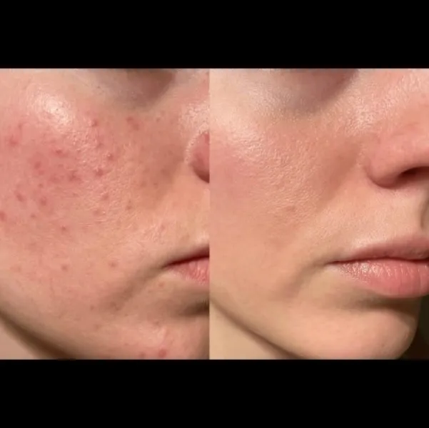 Best Acne Treatment In Turbhe