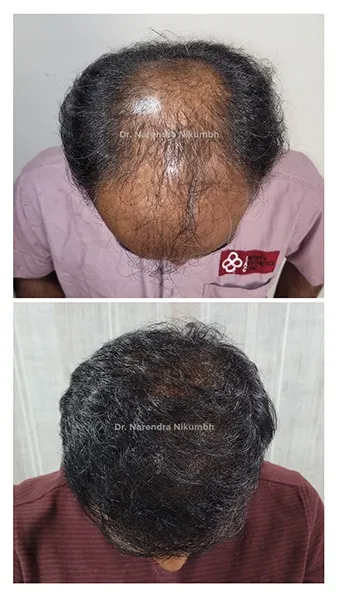 Life Changing Hair Transplant Surgery in Thane