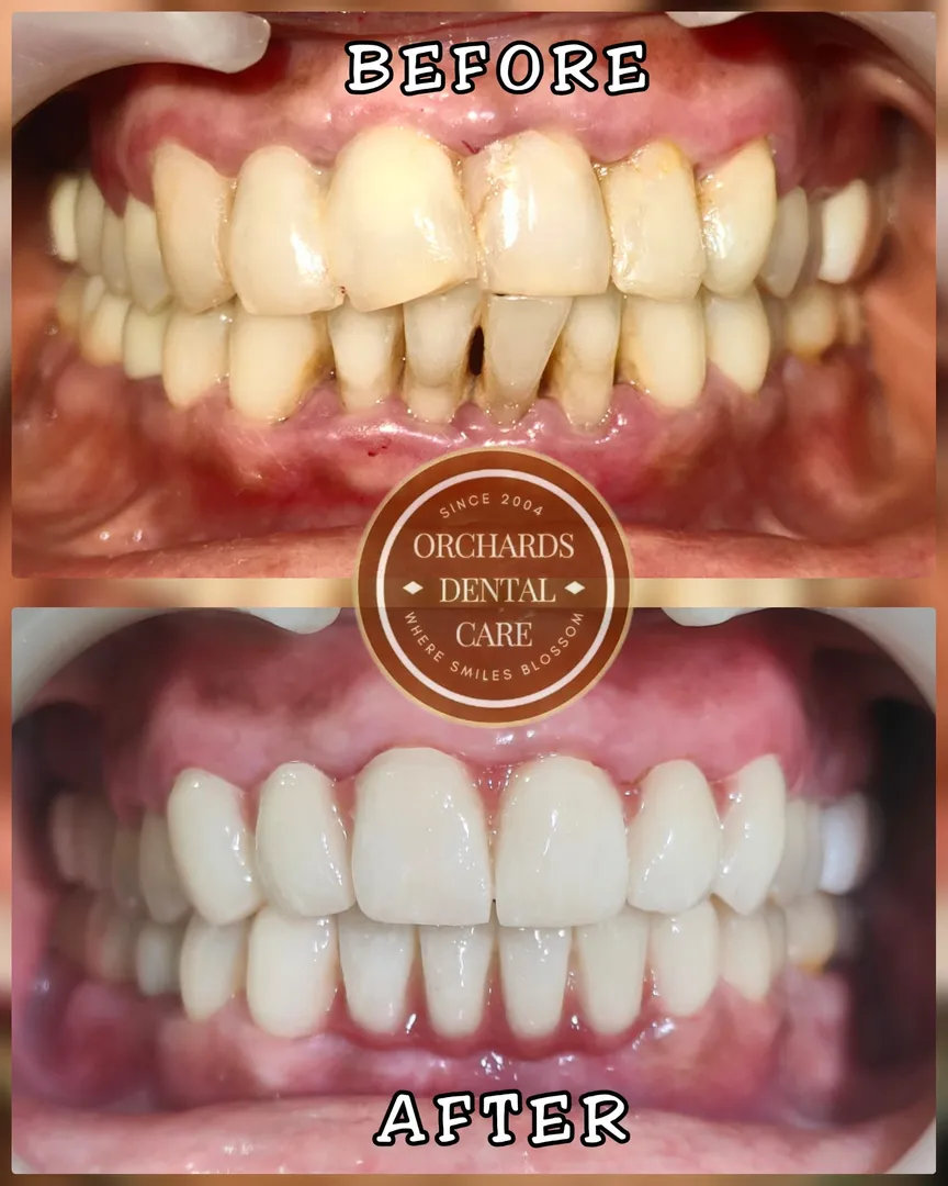 From breakage to brilliance ✨🦷