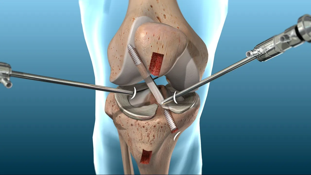 ACL/PCL ligament reconstruction surgeries in Dadar
