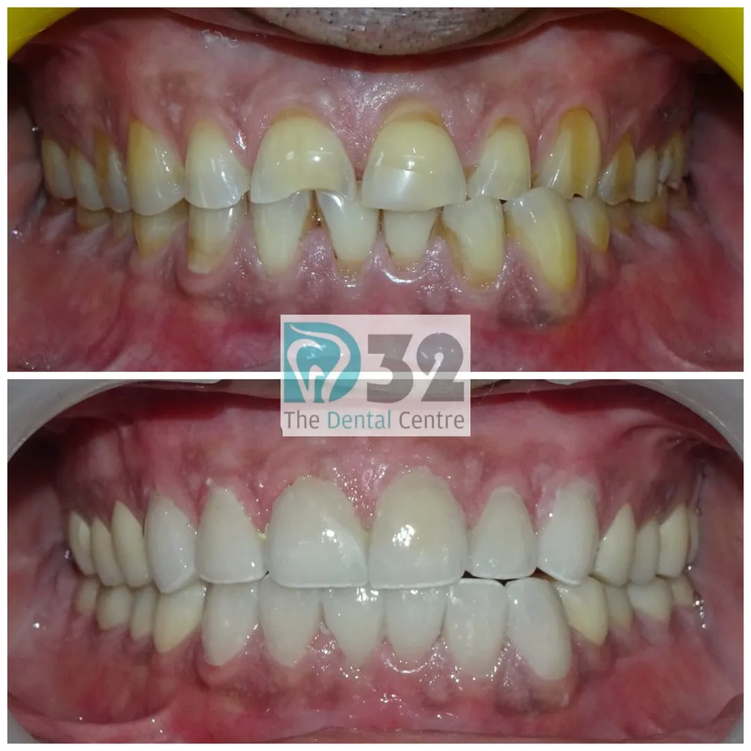 Smile Makeover