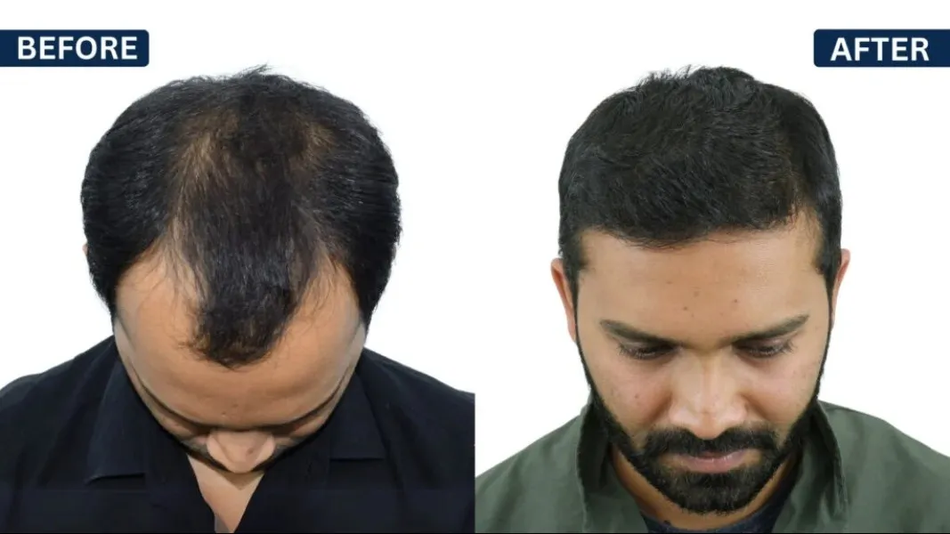 Gindodia Hospital | Hair Loss Treatment Consultants in Dhule