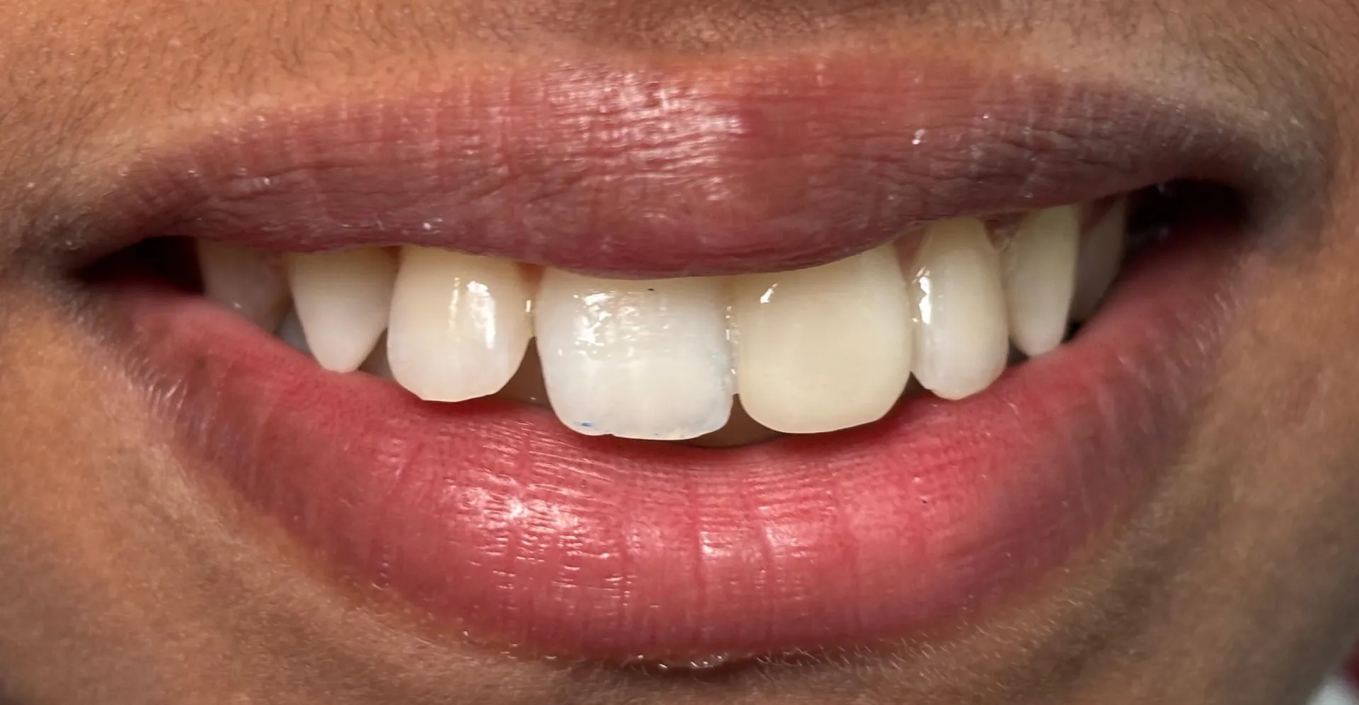 How Safe Is Professional Teeth Whitening at Procare Dental LLP?