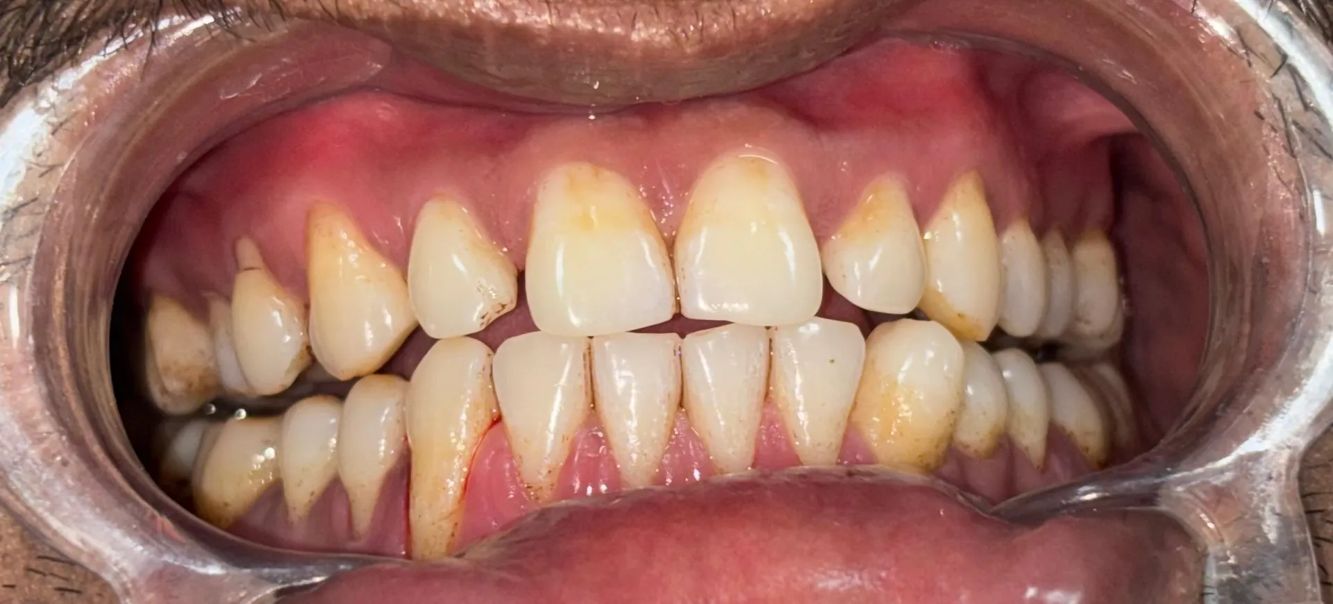 How Often Should You Get Scaling and Polishing Done?