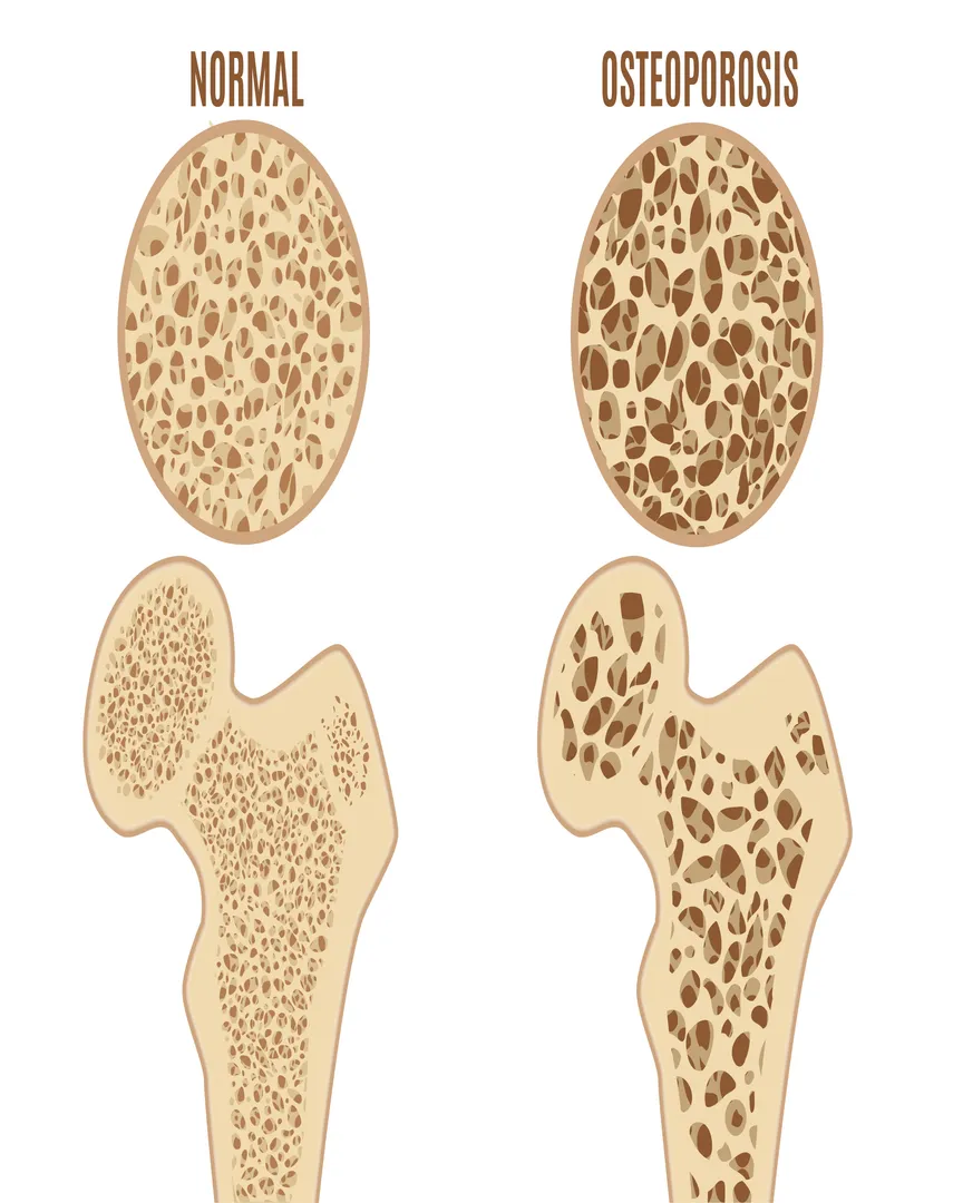 Osteoporosis Treatment in Noida – Strengthen Your Bones and Prevent Fractures