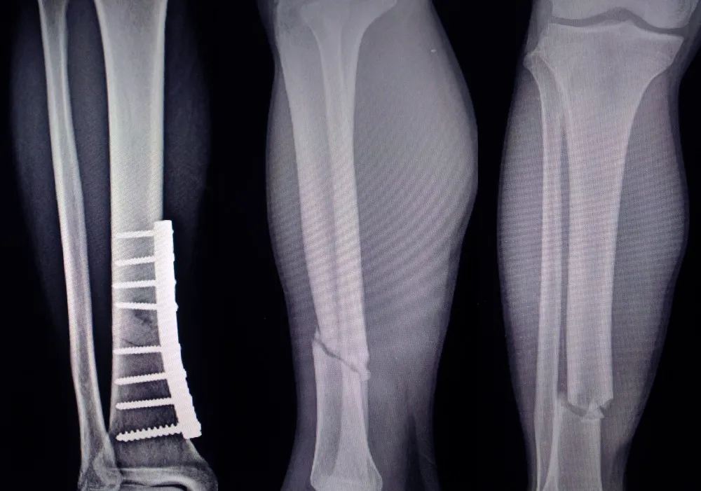 Bone Deformity Treatment in Nagpur – Your Path to Recovery