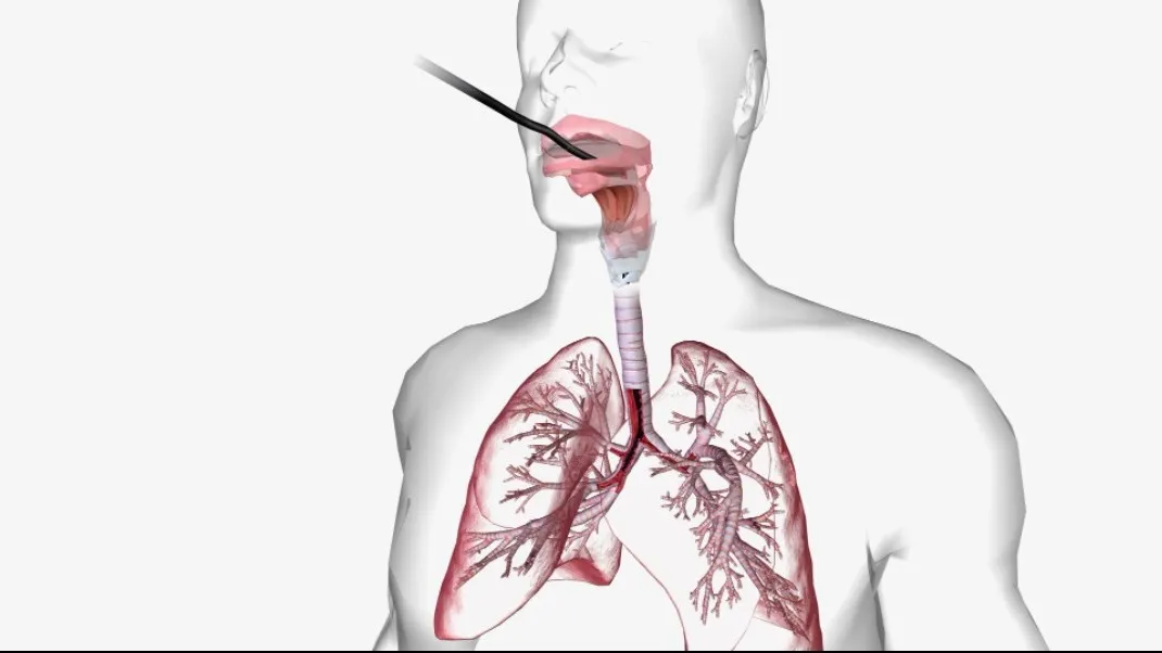 The Role of Bronchoscopy in Lung Disease Diagnosis in Jaipur