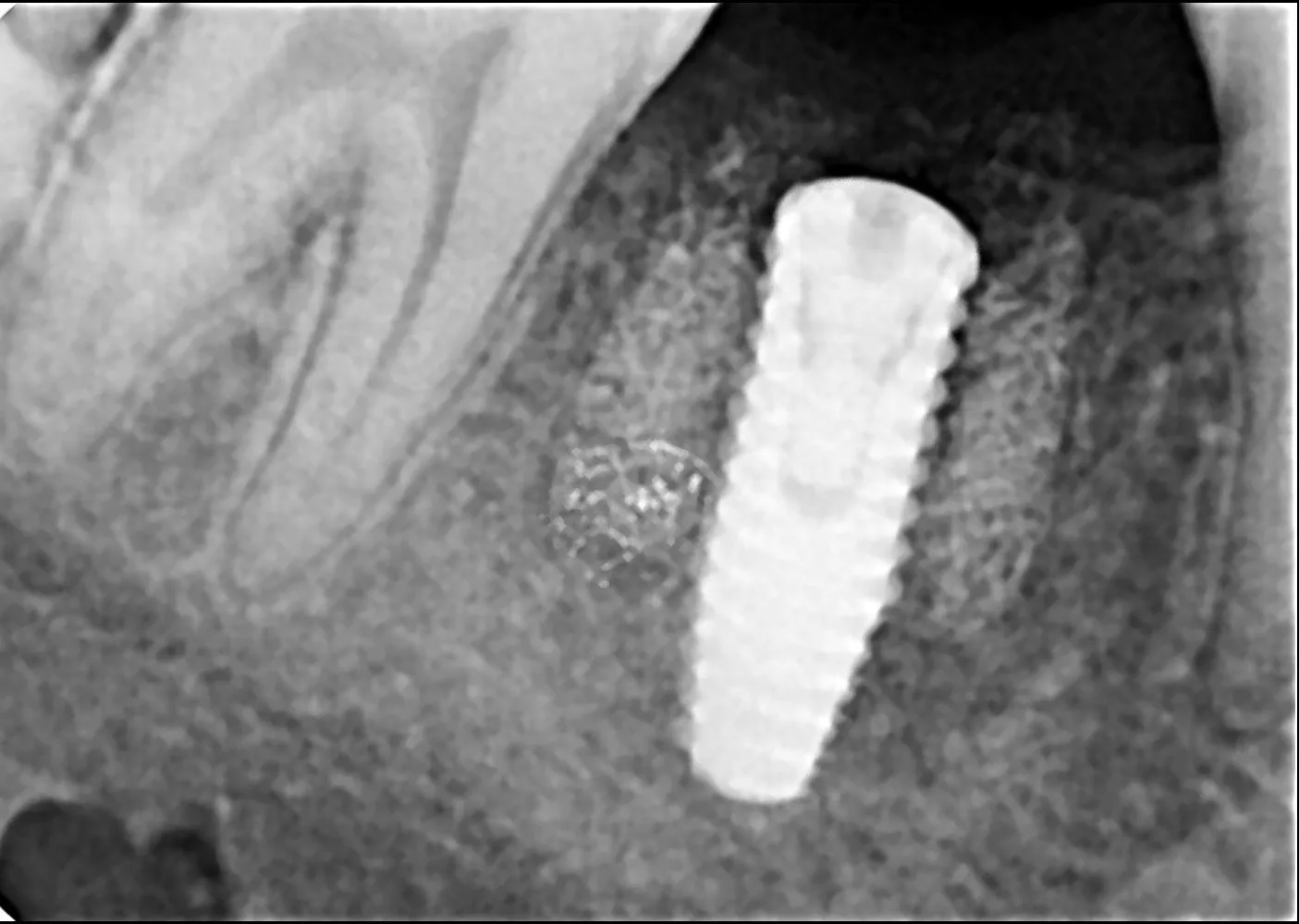 How Many Days Does It Take to Get a Dental Implant?