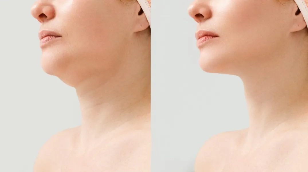 Neck Lift in Bangalore – Restore a Defined Jawline Naturally