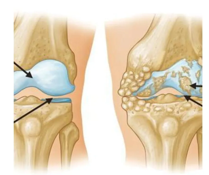Avoid Knee Replacement Surgery