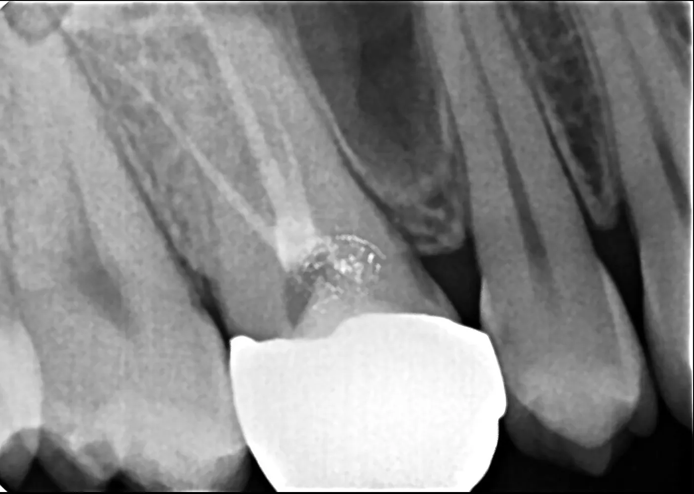 Dental Crown After Root Canal – Is It Compulsory?