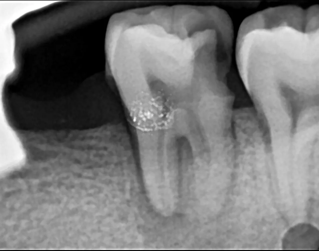 Signs That You May Need a Root Canal
