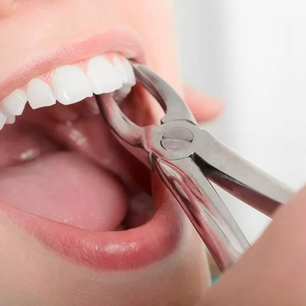 Best Tooth Extraction in vashi