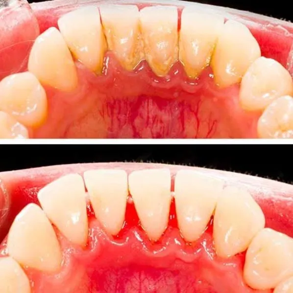 Scaling for Gum Disease – How It Helps