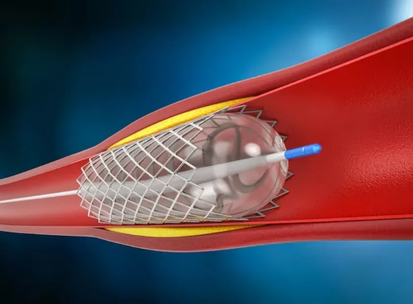 Angiography in Aundh – A Clear View of Your Heart’s Blood Flow