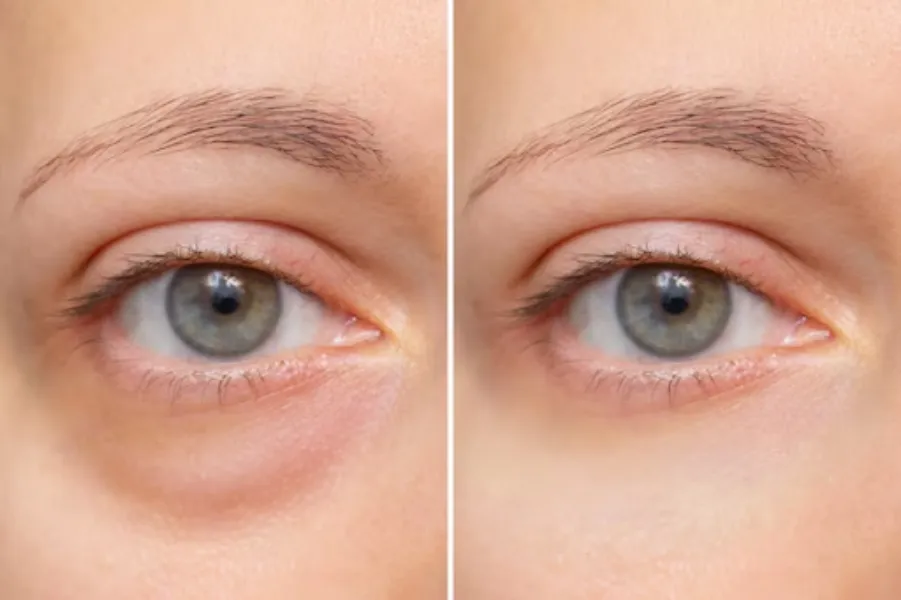 Blepharoplasty in Bangalore – Refresh Tired Looking Eyes