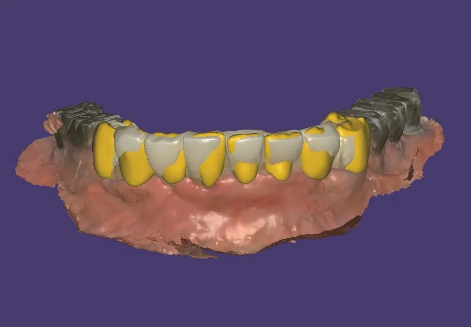 Digital Smile Design – Plan Your Smile Before Treatment