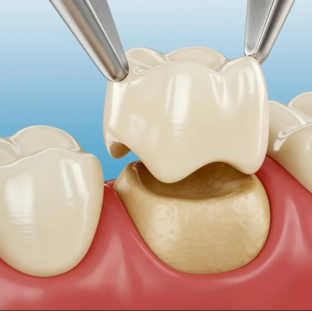 Zirconia Crowns in Hauz Khas, New Delhi