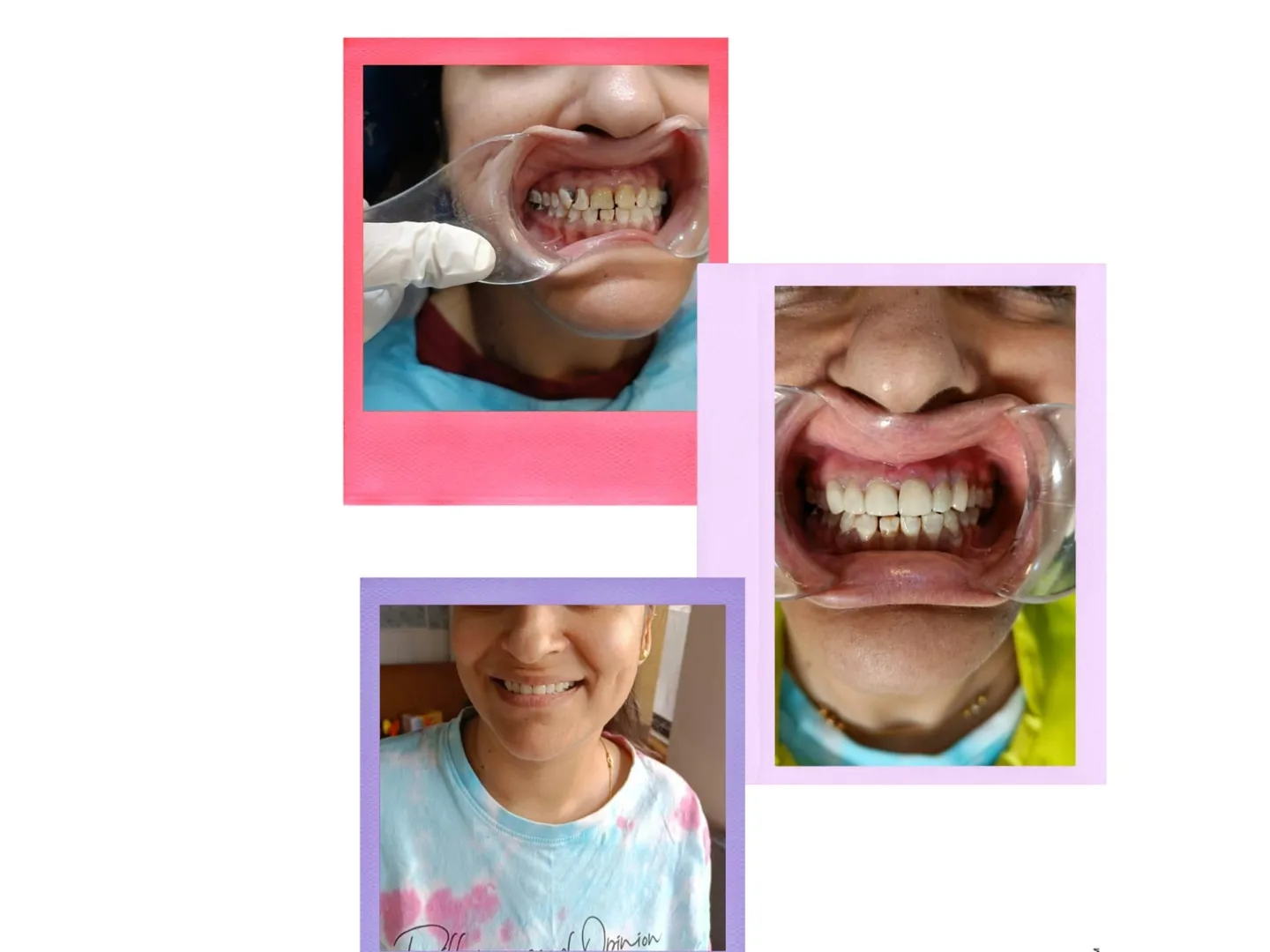 Smile Makeover in Gaur City