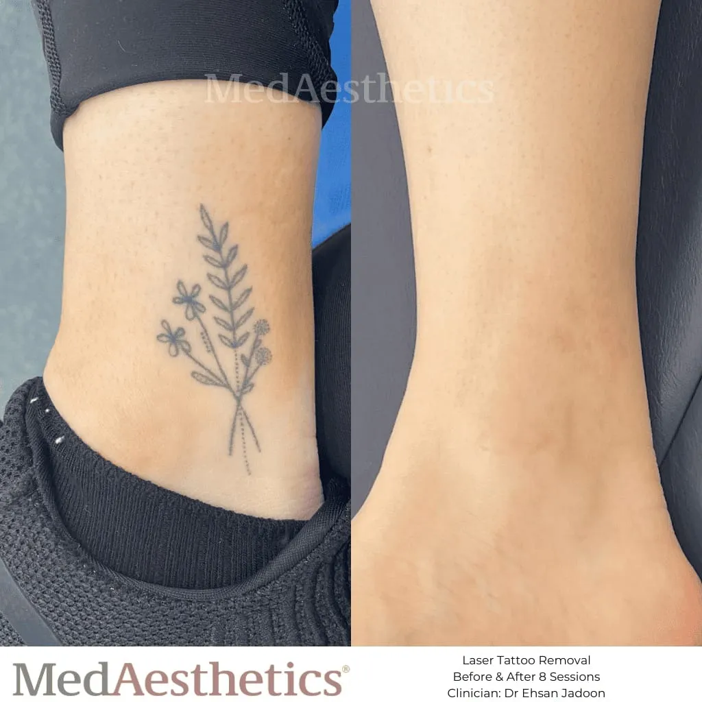 Best Tattoo Removal Treatment In Turbhe
