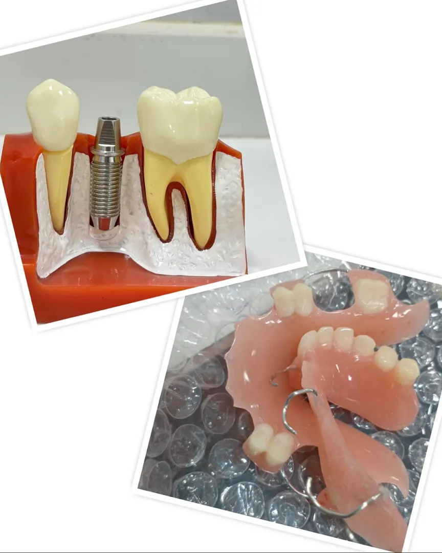 Benefits of Dental Implants Over Removable Dentures