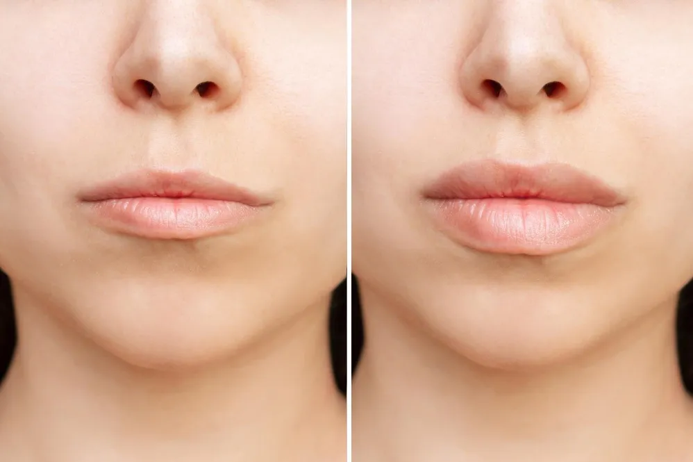 Lip Lift in Bangalore – Enhance Natural Lip Proportions