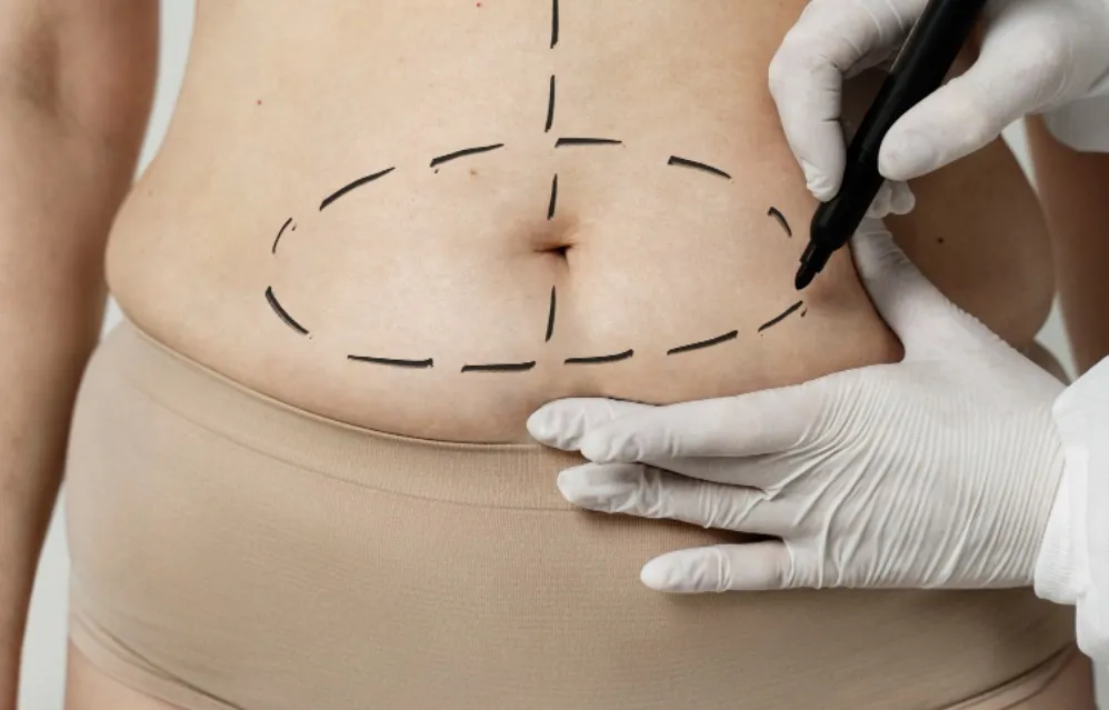 Lipoma Removal Surgery in Sion for Safe and Neat Results