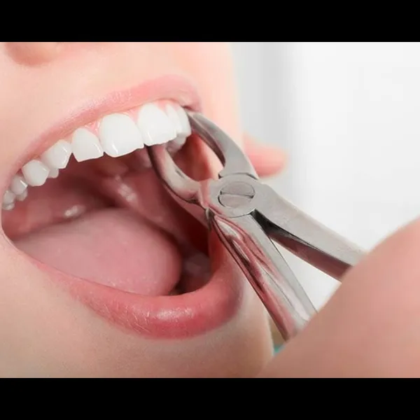 Best Tooth Extraction Treatment In Rabale