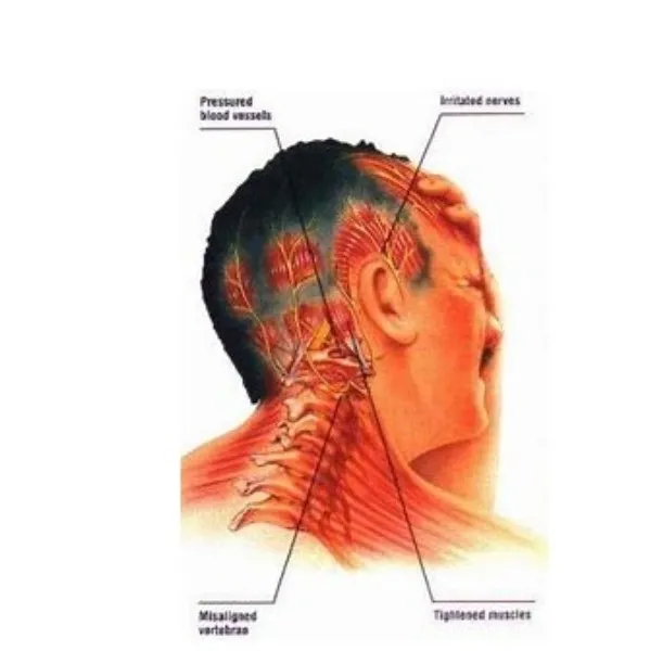 Migraine or Neck-Related Headache? Don’t Confuse the Two