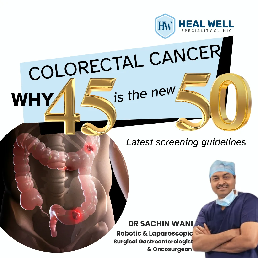 Colorectal Cancer: Why 45 is the New 50