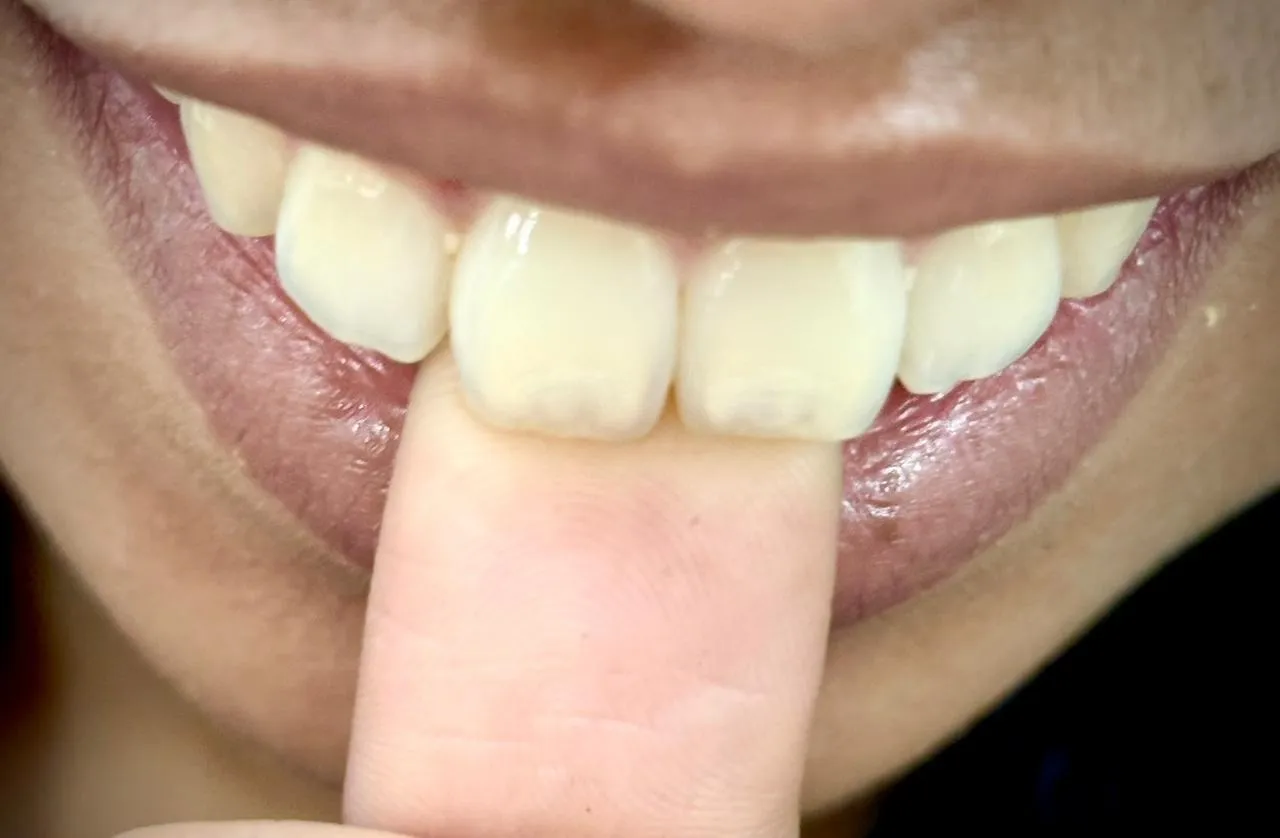 Thumb Sucking – When Does It Affect Teeth?
