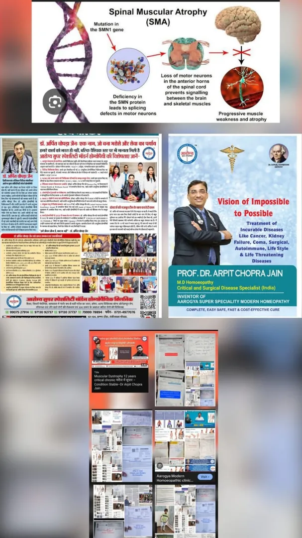 स्पाइनल मस्कुलर एट्रोफी (एसएमए) - डॉ. अर्पित चोपड़ा जैन की आधुनिक होम्योपैथी की संचयी उपचार आशा Spin...