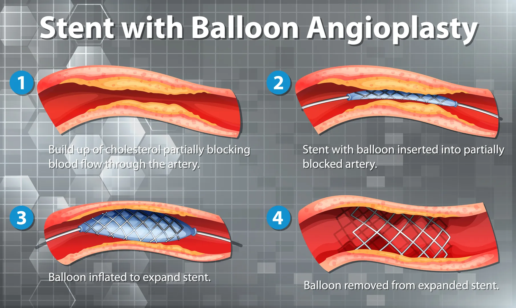 Angioplasty in Baner – Opening Blocked Arteries for a Healthier Life