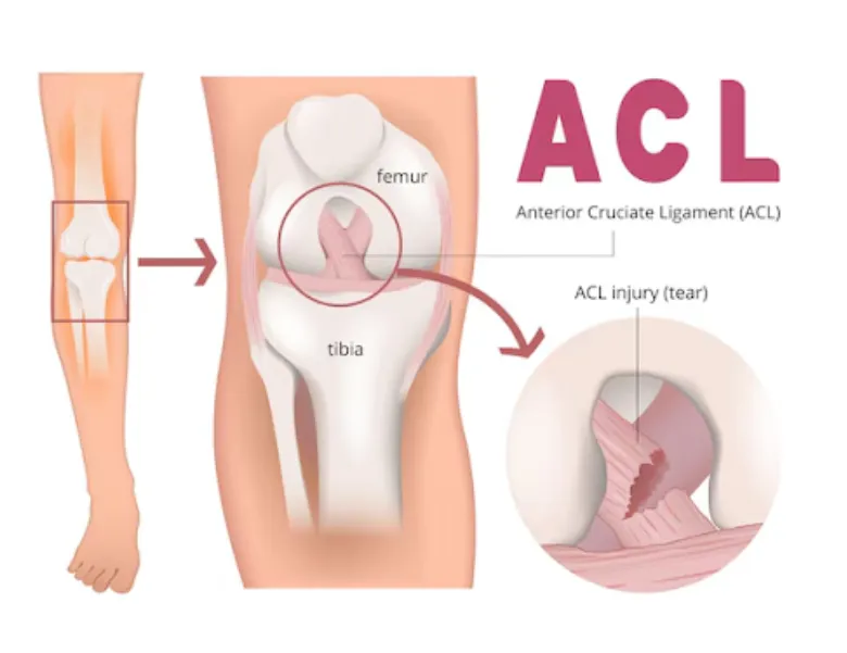 ACL Surgery Specialist in Noida – Restore Stability and Mobility in Your Knee