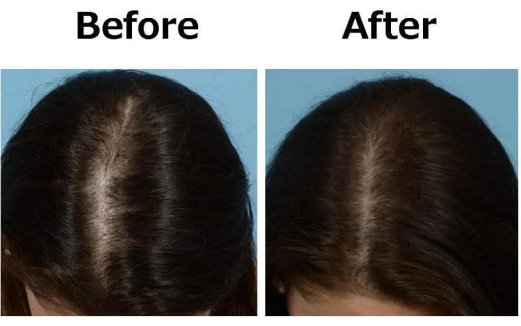 Best Hair PRP Treatment in Belapur