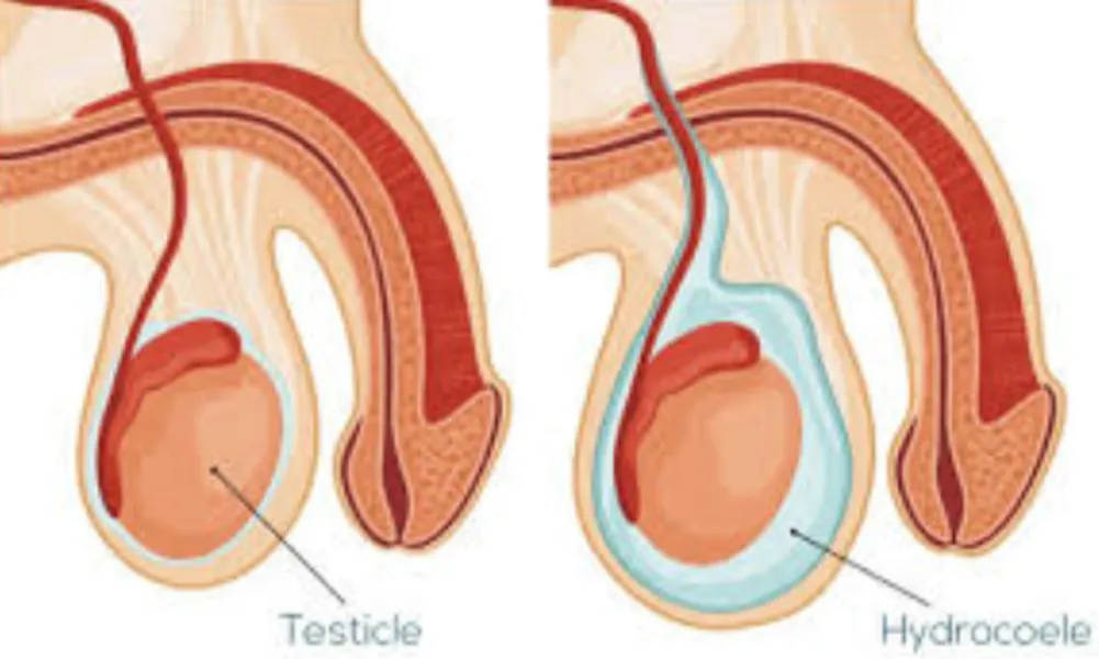 Hydrocele Treatment in Mumbai: Minimally Invasive Surgery Options