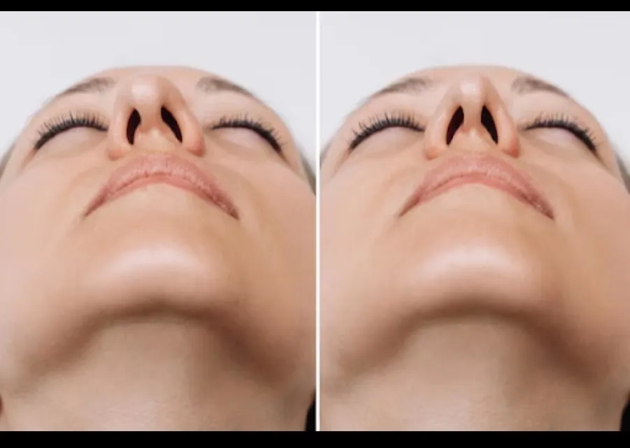 Septoplasty in Bangalore – Improve Breathing Comfort Effectively