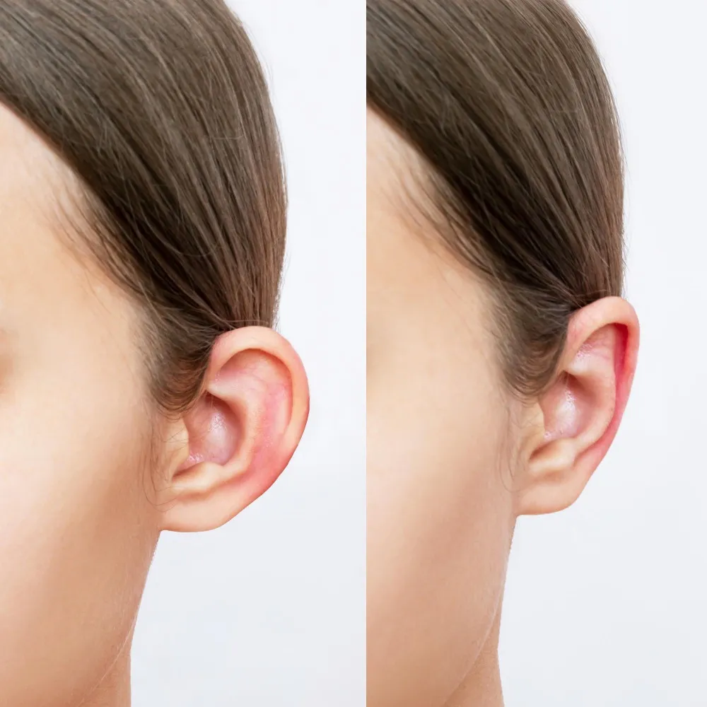 Otoplasty in Bangalore – Correct Prominent Ears with Natural Results