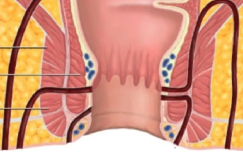 Fissure Treatment in Kolathur, Chennai – Relief from pain that lingers